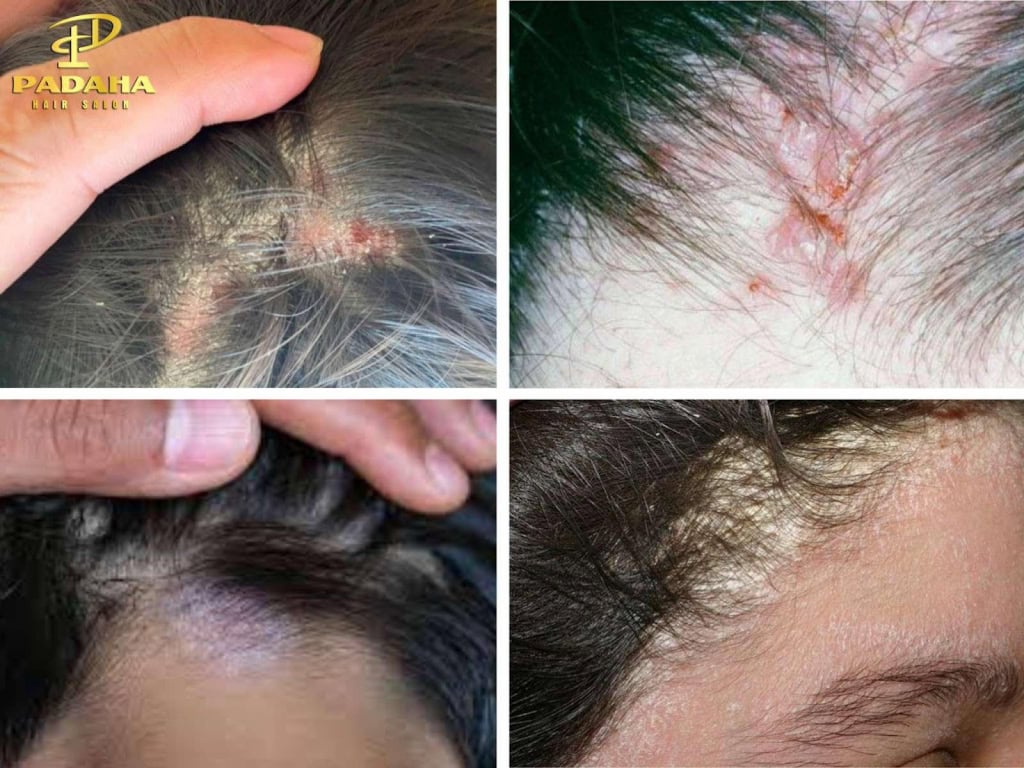 Nấm da đầu có các dấu hiệu nhận biết rõ rệt qua các giai đoạn như ngứa kéo dài