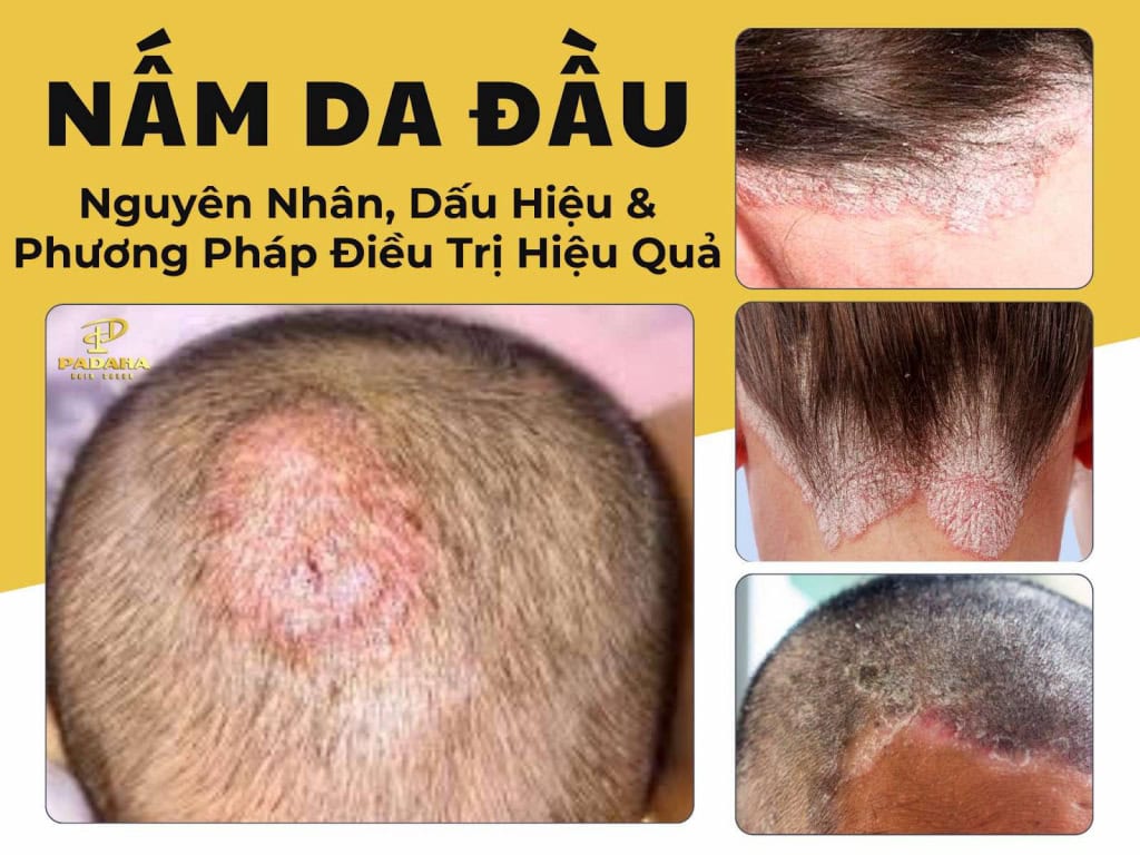 Nấm Da Đầu