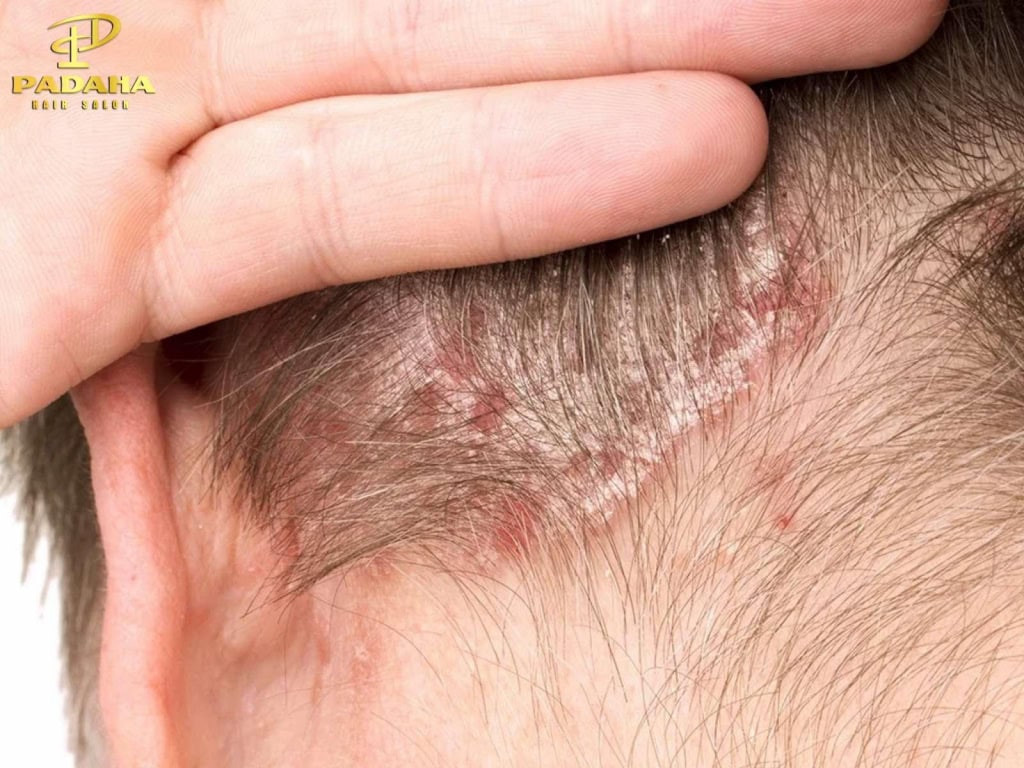 Nấm da đầu thường khởi phát khi có sự kết hợp giữa môi trường nóng ẩm