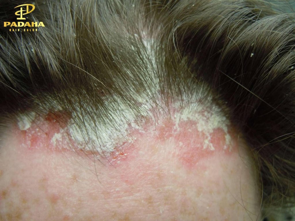 Nấm da đầu là tình trạng nhiễm trùng do các loại nấm sợi (dermatophytes) gây ra