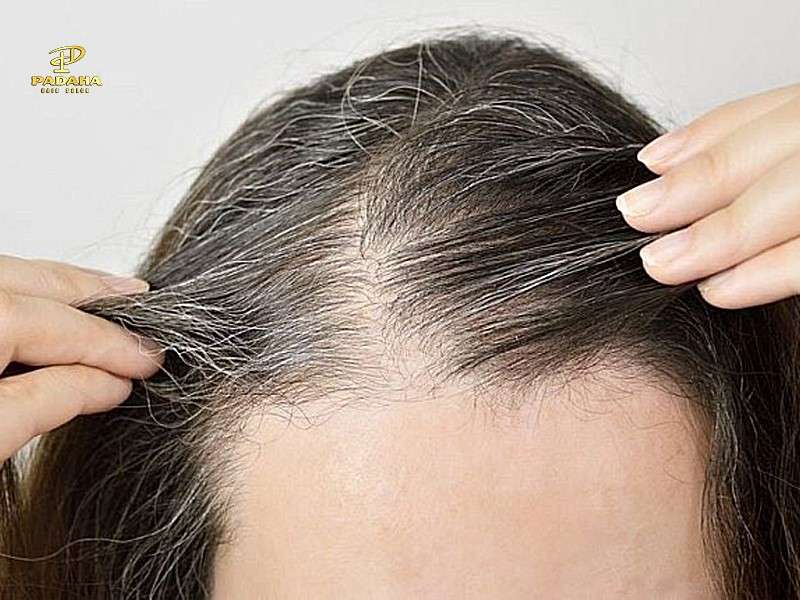 Nguyên Nhân Nào Gây Ra Tình Trạng Tóc Mỏng Và Bạc Ở Tuổi Trung Niên?